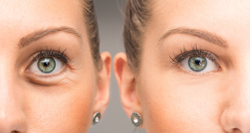 Blefaroplastia: cuidados preoperatorios y postoperatorios