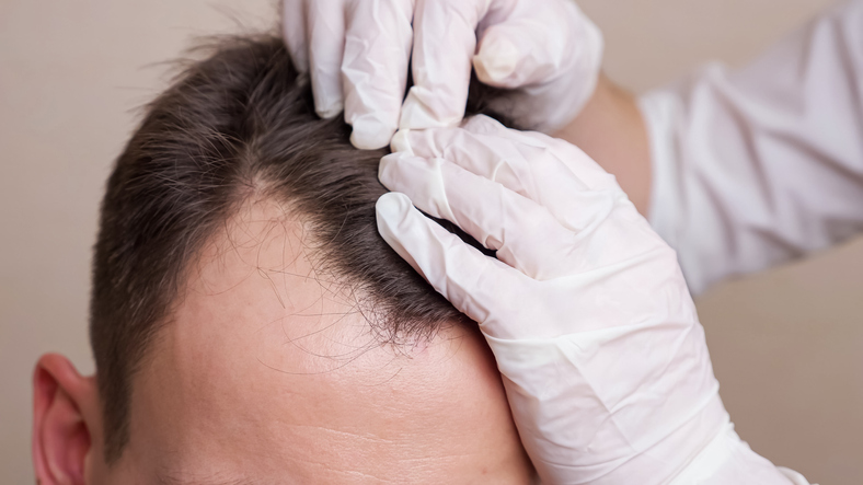 Injerto Capilar, solución eficaz para la caída del cabello