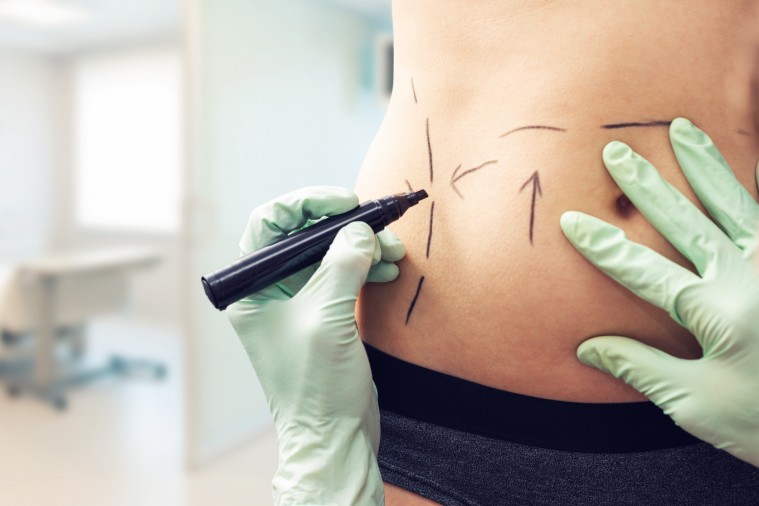 Diferencia entre liposucción y lipoescultura