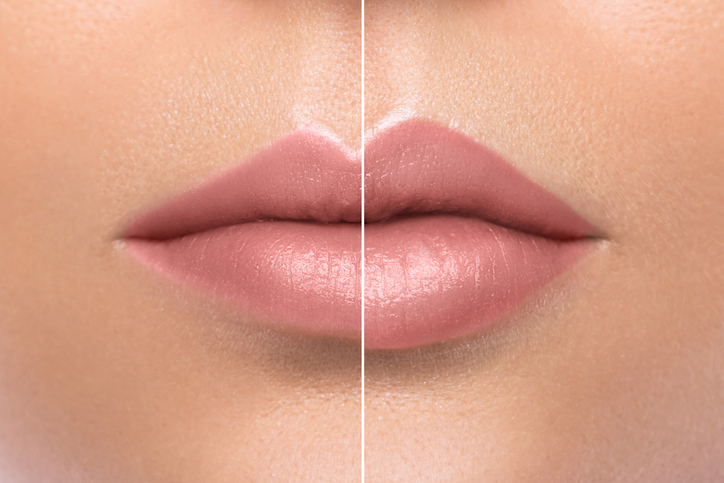 Tus labios más jóvenes que nunca gracias al ácido hialurónico