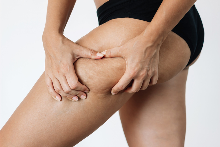 La evolución del lipedema , tipos y pronóstico